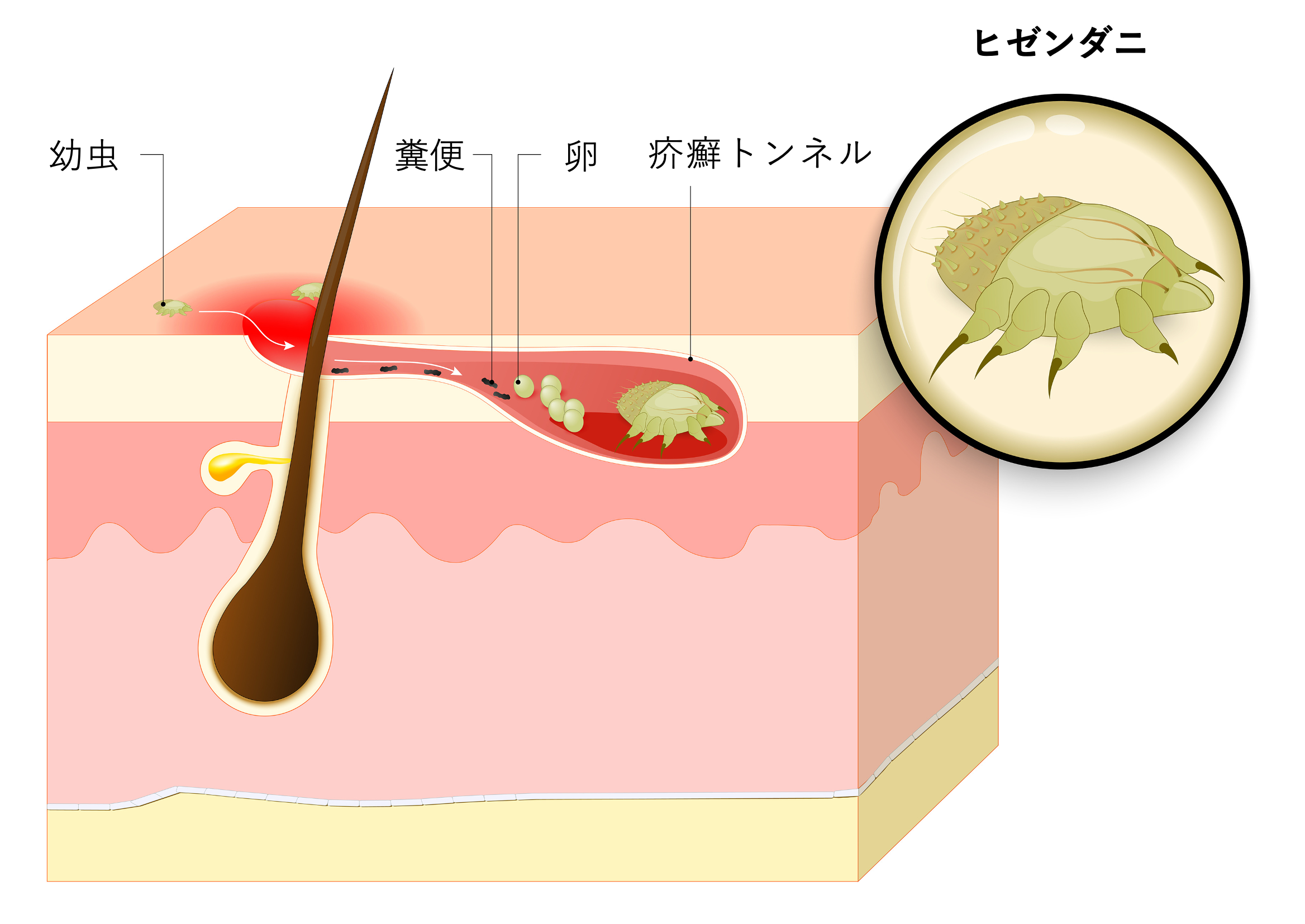 疥癬トンネルとは？画像でわかりやすく解説