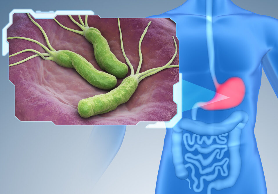 ピロリ菌感染症とは？原因と感染経路、ピロリ菌検査と除菌治療を解説