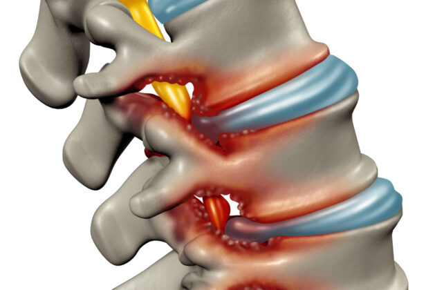 脊柱管狭窄症とは？原因と症状、手術による治療がケースを解説