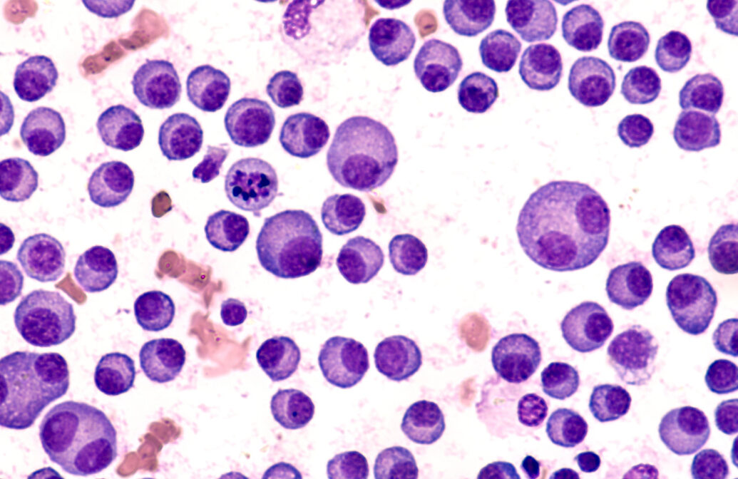多発性骨髄腫の危険因子は何ですか?