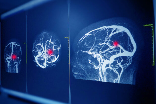 クモ膜下出血とは？前兆となる症状と原因、生存率と後遺症を解説