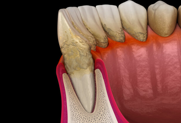 歯周病とは？歯肉炎・歯周炎の症状と原因、治療法を解説