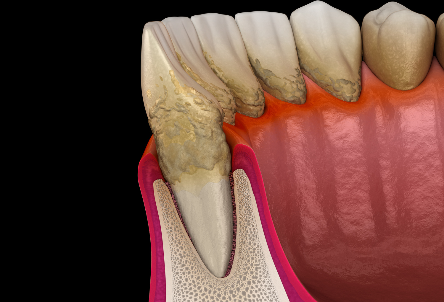 歯周病とは？歯肉炎・歯周炎の症状と原因、治療法を解説