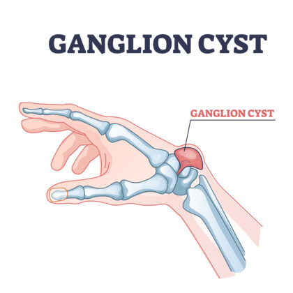 ガングリオン｜手関節などにできる腫瘤（しゅりゅう）で、「こぶ」のような形状が特徴的です。がんとは違い、悪性のものではありません。