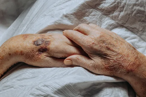 高齢者に起こりやすい「あざ」 - 老人性紫斑