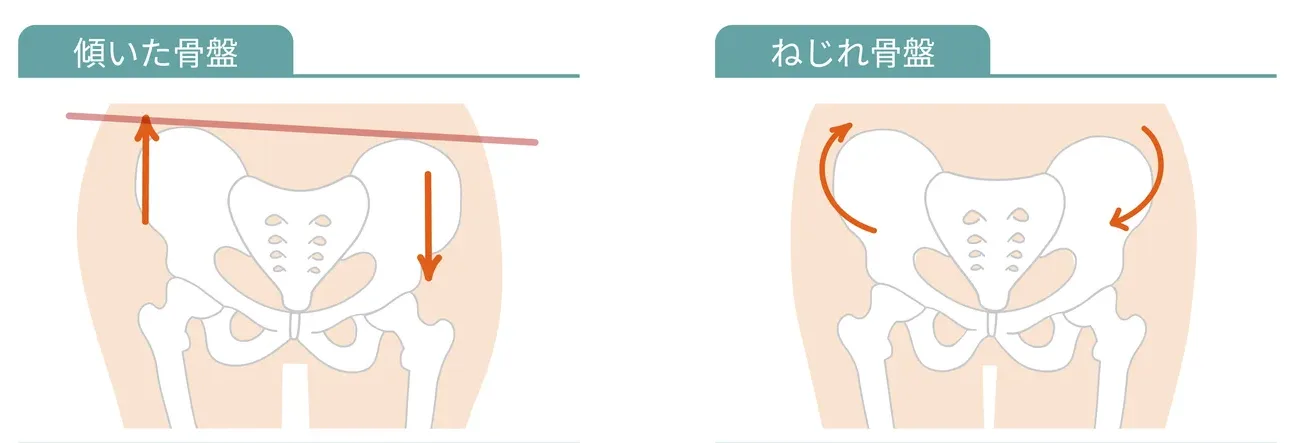 脚のつけ根・股関節が片方（右・左）だけ痛い