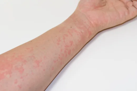 発疹や皮膚を触ると熱く感じる原因は何ですか?