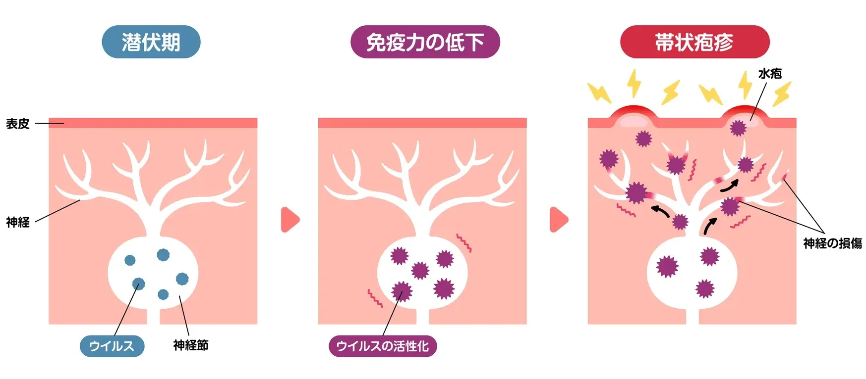 内部帯状疱疹を患った人の今後の見通しはどうなりますか?