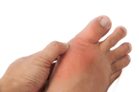 足の親指のつけ根が赤く腫れる