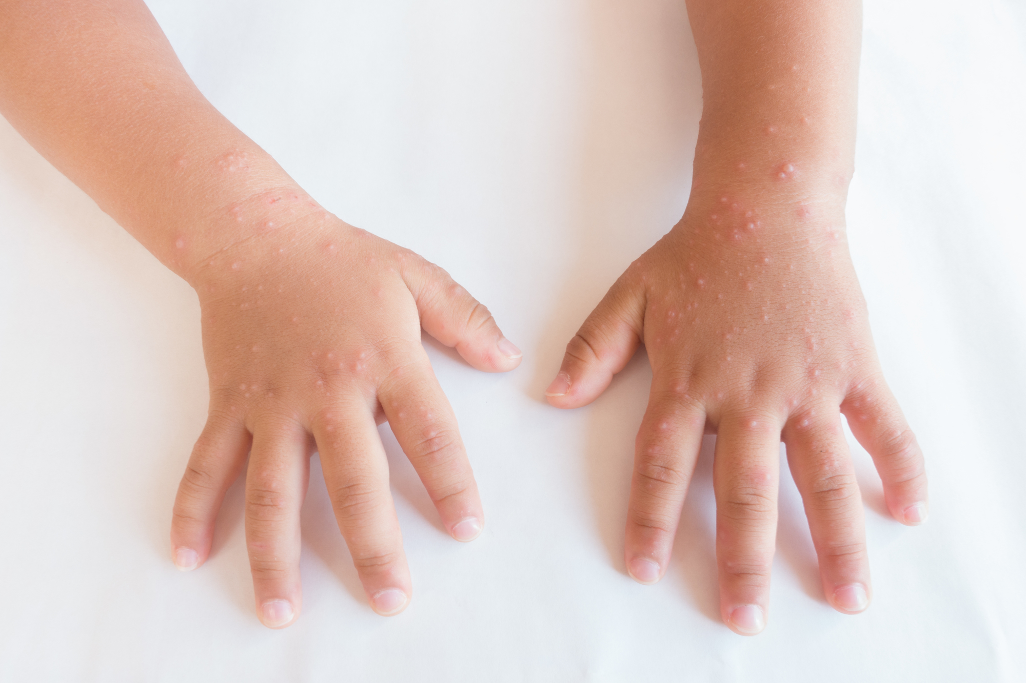 手足口病による下痢の危険因子は何ですか?