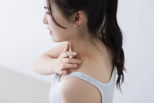 蕁麻疹(じんましん)とは?原因と治し方、身に覚えのないミミズ腫れを写真で解説