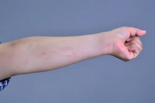 皮膚の「むくみ（ミミズ腫れ）」と「かゆみ」が出たり短時間で消えてしまったりする症状がみられる場合、蕁麻疹（じんましん）という皮膚疾患が疑われます。