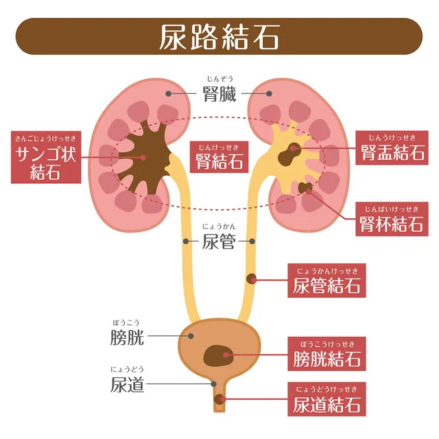 尿路結石の種類｜尿路結石症は、尿の流れる経路（腎臓から尿道へ）に、この結石が生成される場所によって病態の名称が異なります。