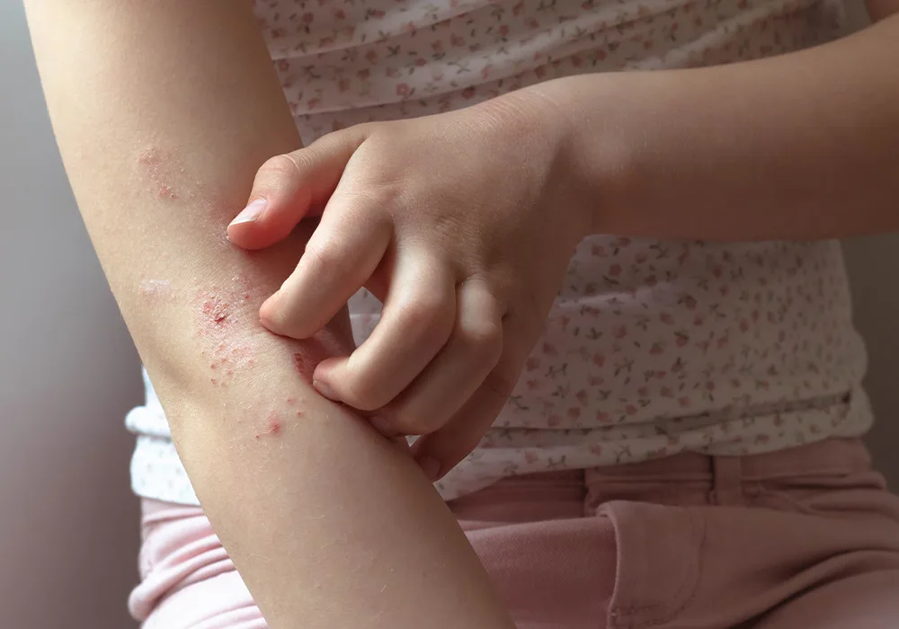 痒疹とは？かゆみの強い虫刺されのような発疹が増える症状と原因を解説